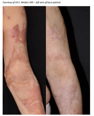 Early Treatment Is Revolutionizing Outcome Of Burn Scars